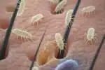 Demodex: Ácaro Invisível Causa Acne, Rosácea e Queda de Cílios