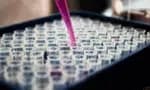 Estudos brasileiros identificam exame de sangue para diagnóstico precoce de Alzheimer